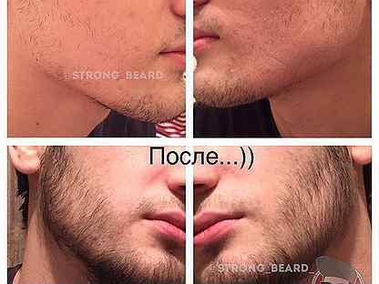 Миноксидил для бороды до и после с фото